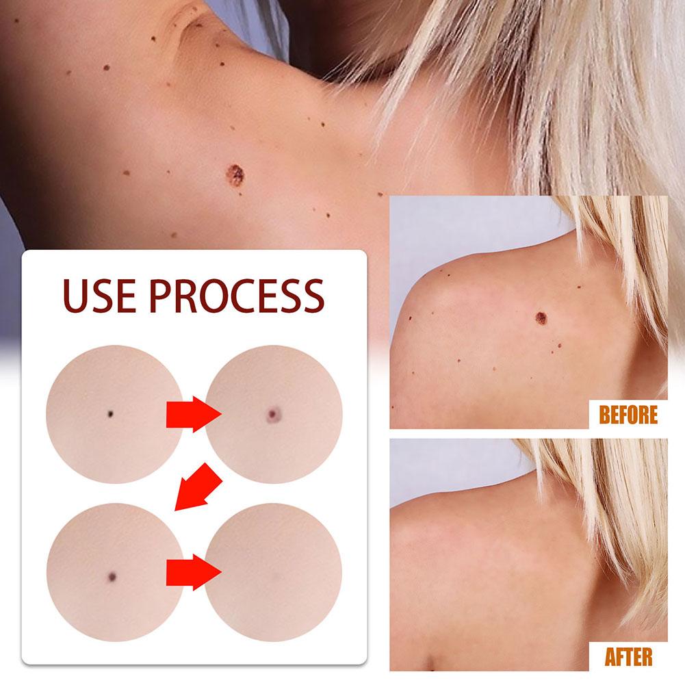 Tags and Moles Remover