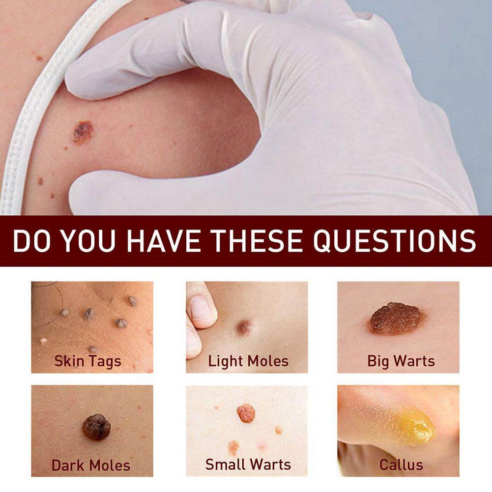 Tags and Moles Remover