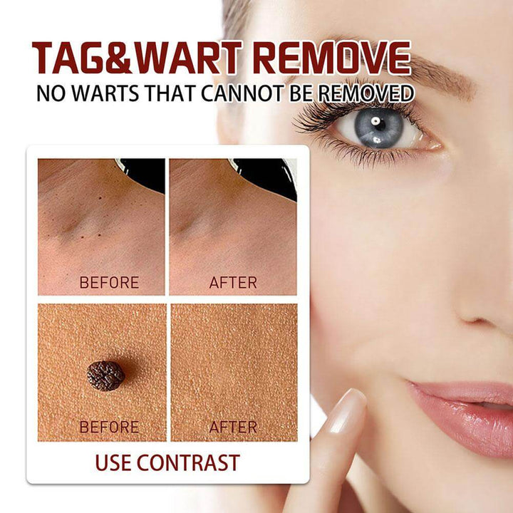 Tags and Moles Remover